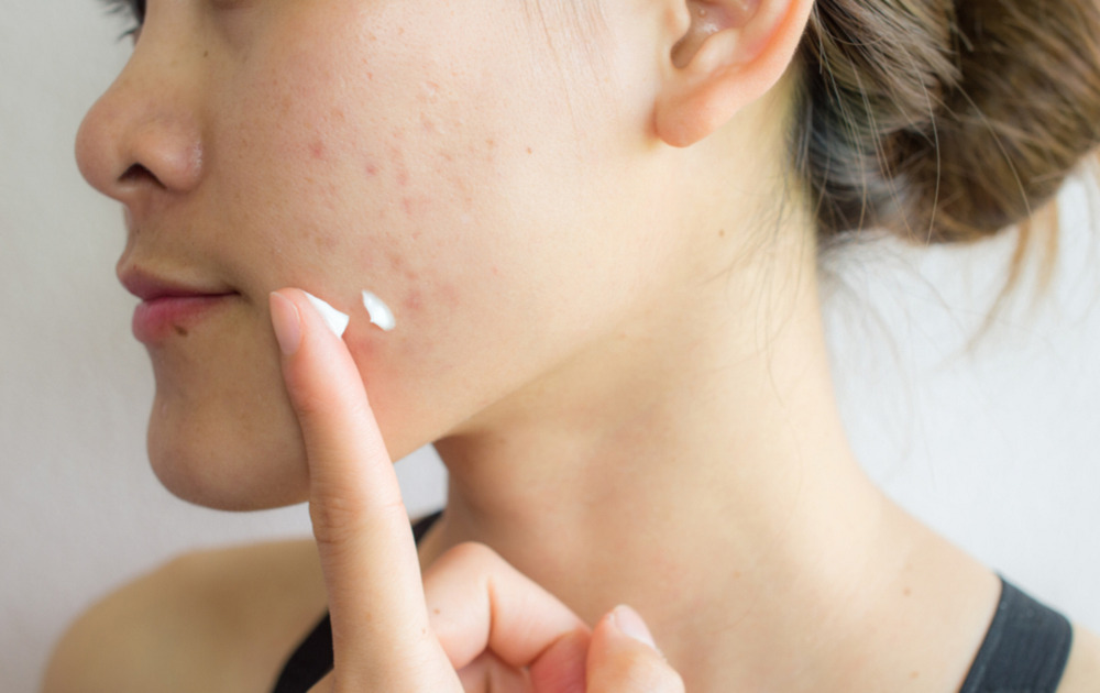 Cách chăm sóc da mặt bị mụn không phải ai cũng biết